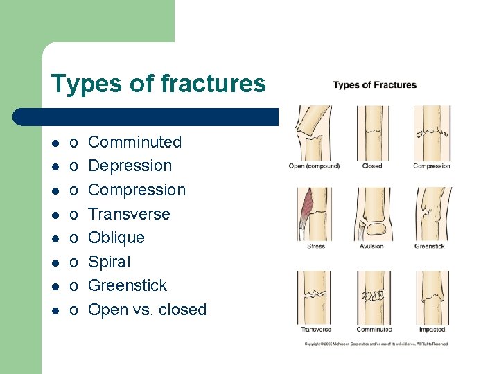 Types of fractures l l l l o Comminuted o Depression o Compression o