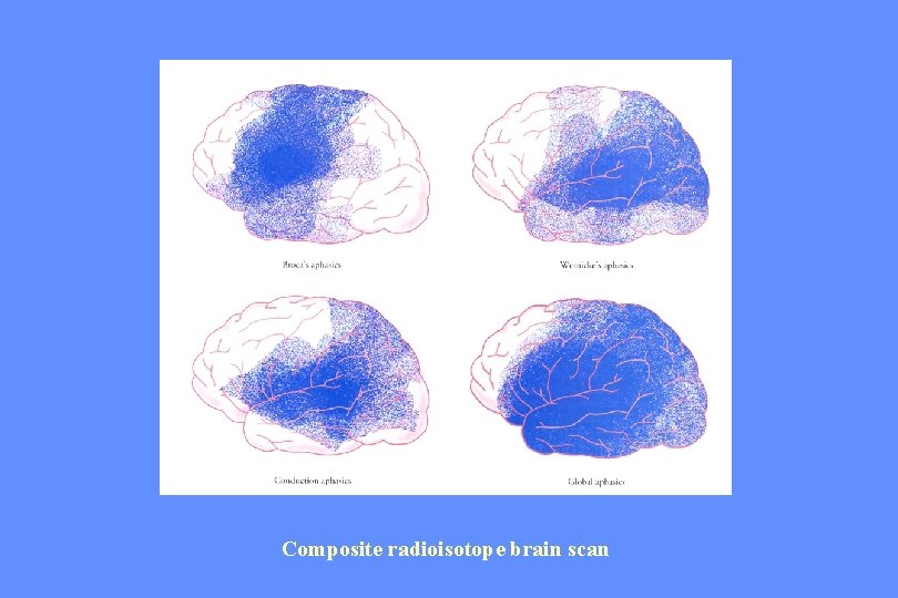 Composite radioisotope brain scan 