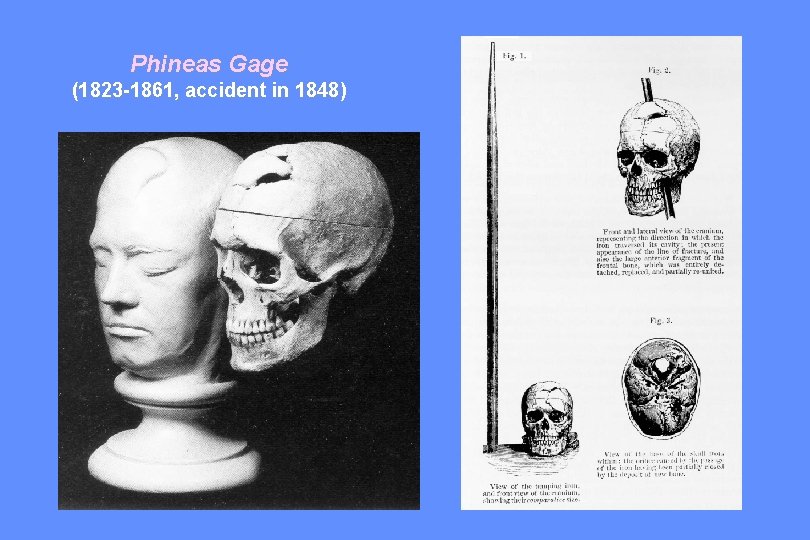 Phineas Gage (1823 -1861, accident in 1848) 