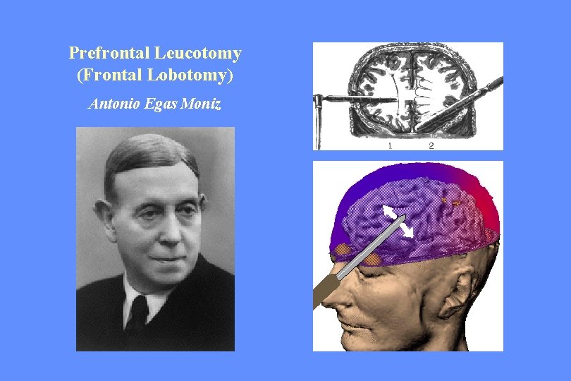Prefrontal Leucotomy (Frontal Lobotomy) Antonio Egas Moniz 