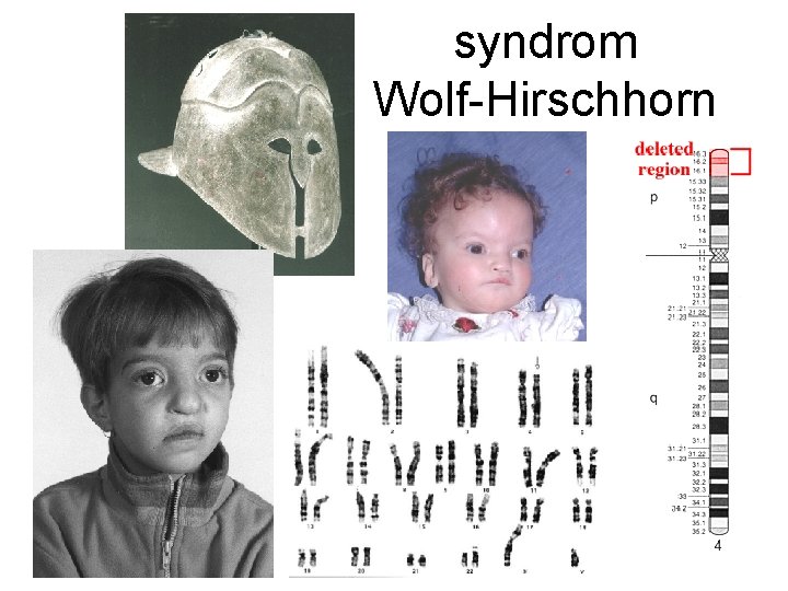 syndrom Wolf-Hirschhorn 