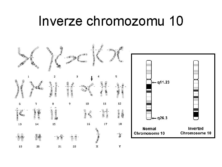 Inverze chromozomu 10 