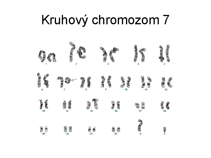 Kruhový chromozom 7 