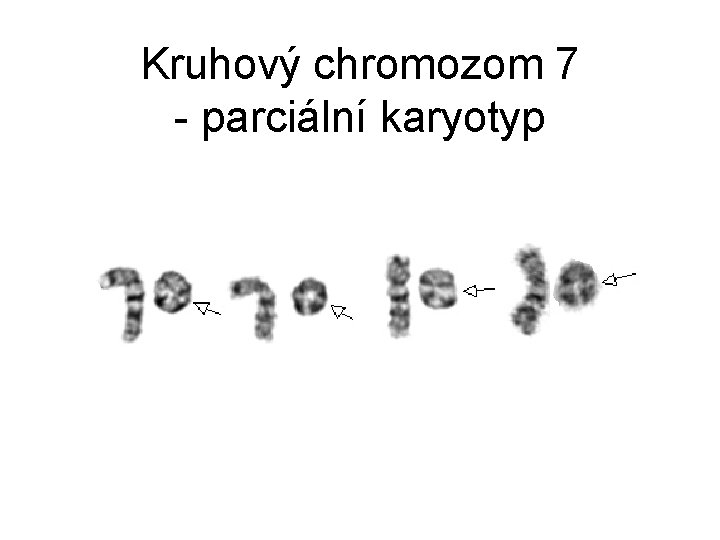 Kruhový chromozom 7 - parciální karyotyp 