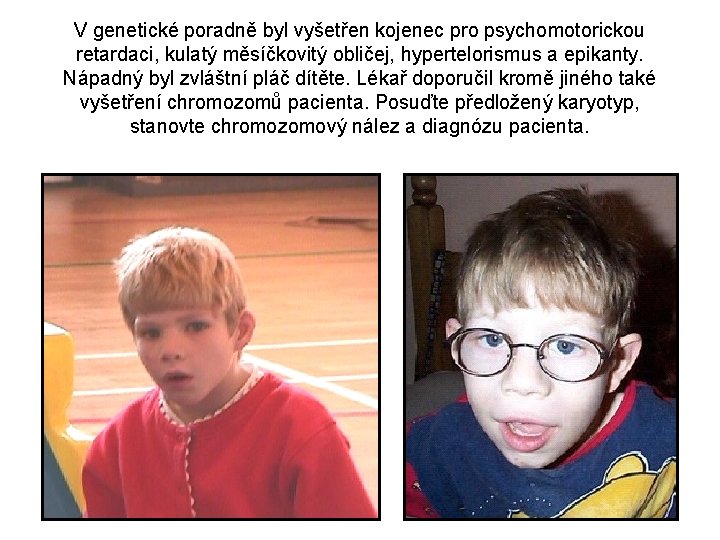 V genetické poradně byl vyšetřen kojenec pro psychomotorickou retardaci, kulatý měsíčkovitý obličej, hypertelorismus a