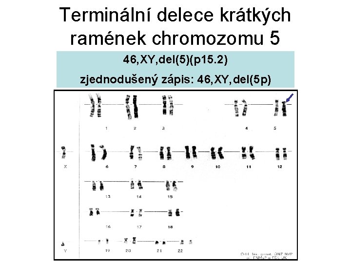 Terminální delece krátkých ramének chromozomu 5 46, XY, del(5)(p 15. 2) zjednodušený zápis: 46,