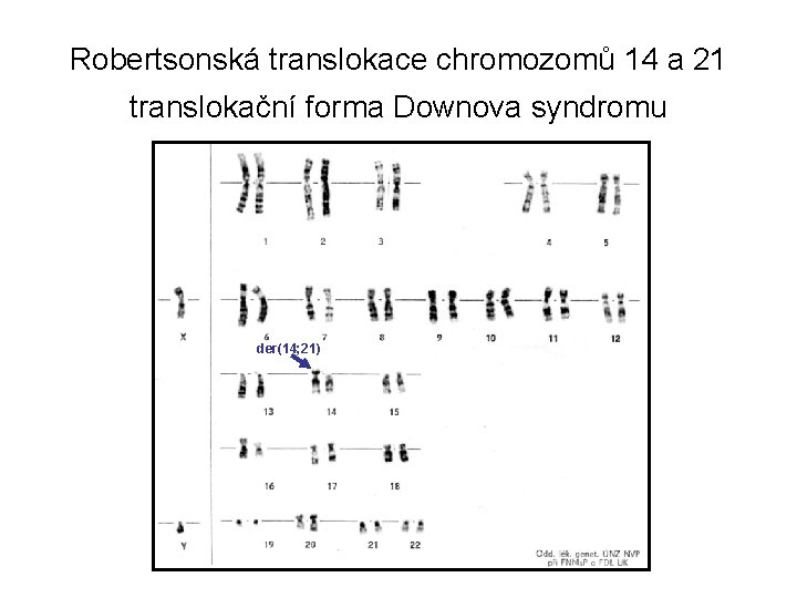 Robertsonská translokace chromozomů 14 a 21 translokační forma Downova syndromu der(14; 21) 