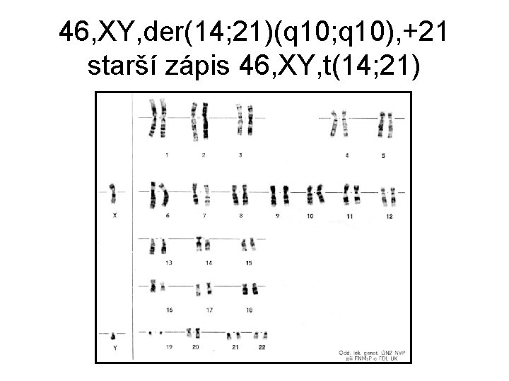 46, XY, der(14; 21)(q 10; q 10), +21 starší zápis 46, XY, t(14; 21)