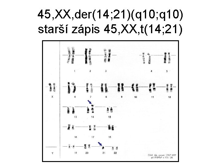 45, XX, der(14; 21)(q 10; q 10) starší zápis 45, XX, t(14; 21) 