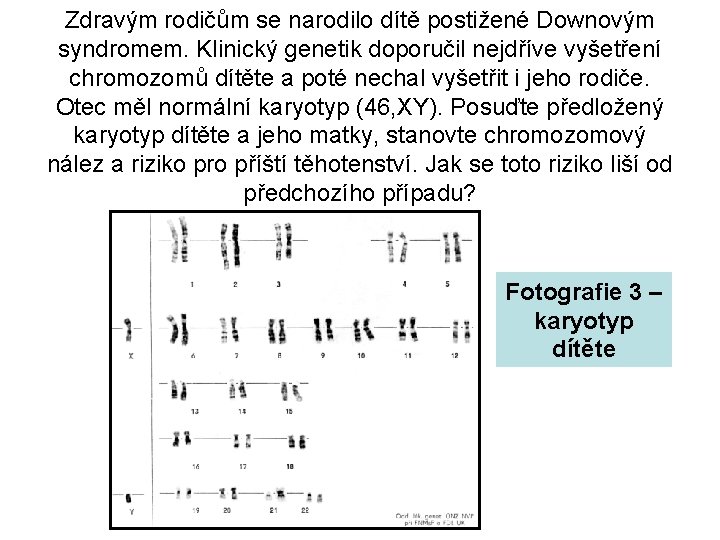 Zdravým rodičům se narodilo dítě postižené Downovým syndromem. Klinický genetik doporučil nejdříve vyšetření chromozomů