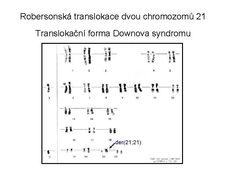 Robersonská translokace dvou chromozomů 21 Translokační forma Downova syndromu der(21; 21) 