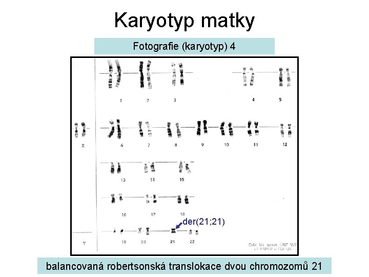 Karyotyp matky Fotografie (karyotyp) 4 der(21; 21) balancovaná robertsonská translokace dvou chromozomů 21 