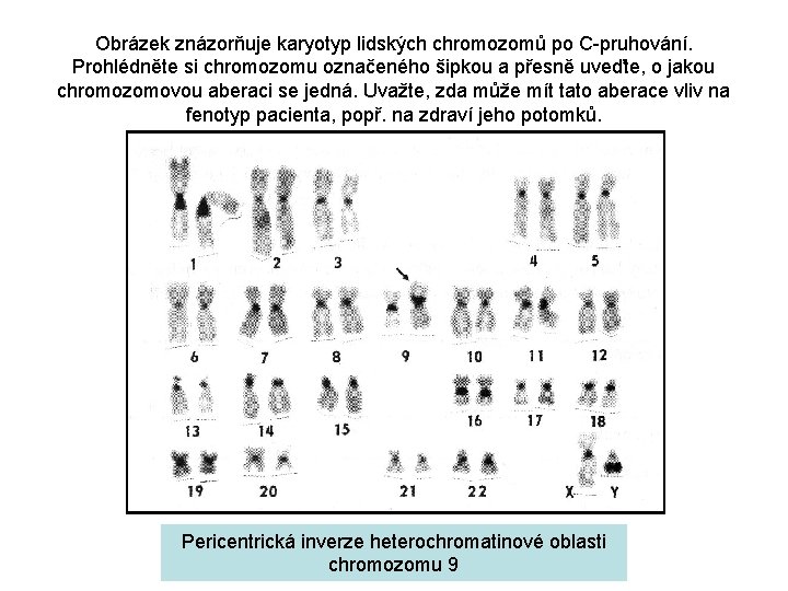 Obrázek znázorňuje karyotyp lidských chromozomů po C-pruhování. Prohlédněte si chromozomu označeného šipkou a přesně