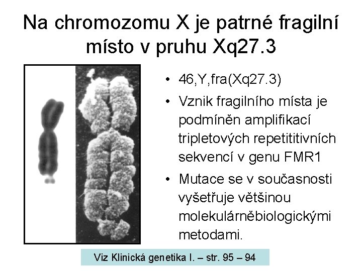 Na chromozomu X je patrné fragilní místo v pruhu Xq 27. 3 • 46,