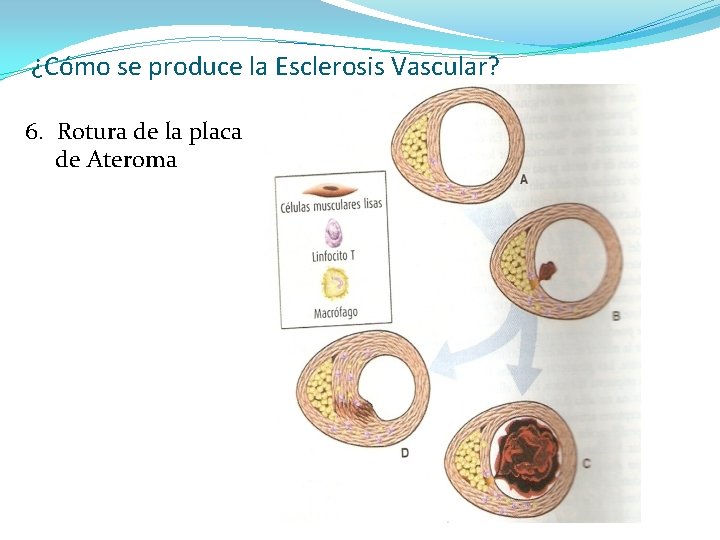 ¿Cómo se produce la Esclerosis Vascular? 6. Rotura de la placa de Ateroma 