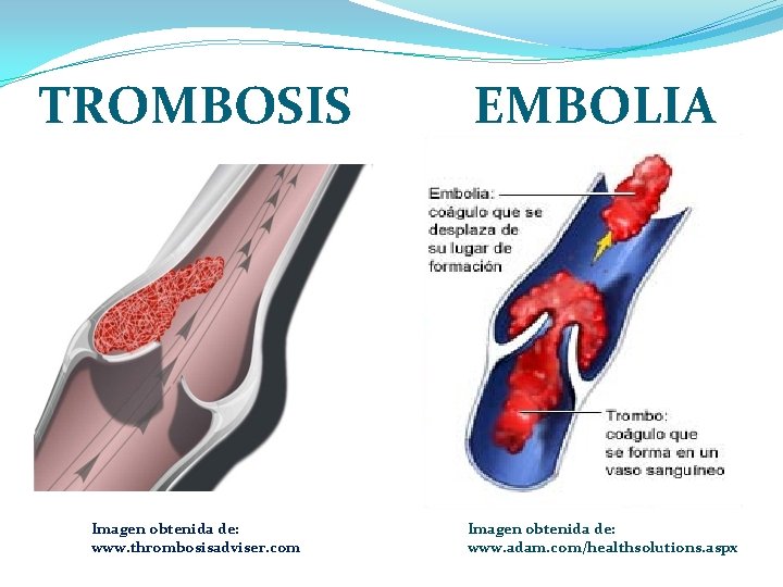 TROMBOSIS Imagen obtenida de: www. thrombosisadviser. com EMBOLIA Imagen obtenida de: www. adam. com/healthsolutions.