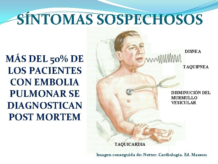 SÍNTOMAS SOSPECHOSOS DISNEA MÁS DEL 50% DE LOS PACIENTES CON EMBOLIA PULMONAR SE DIAGNOSTICAN