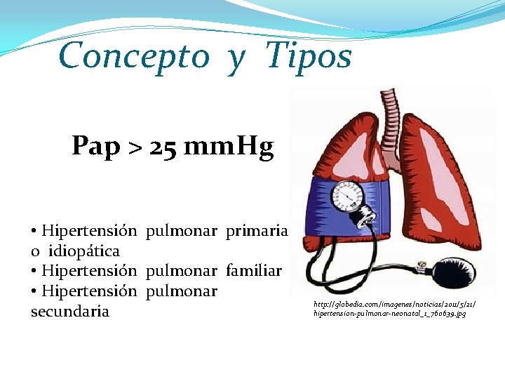 Concepto y Tipos Pap > 25 mm. Hg • Hipertensión pulmonar primaria o idiopática