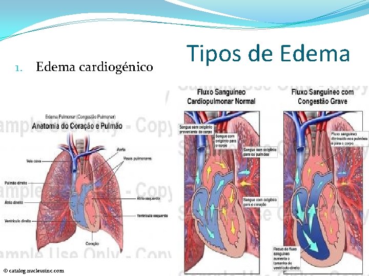 1. Edema cardiogénico © catalog. nucleusinc. com Tipos de Edema 