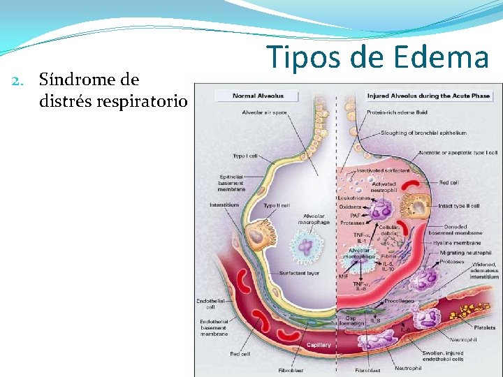 2. Síndrome de distrés respiratorio Tipos de Edema 