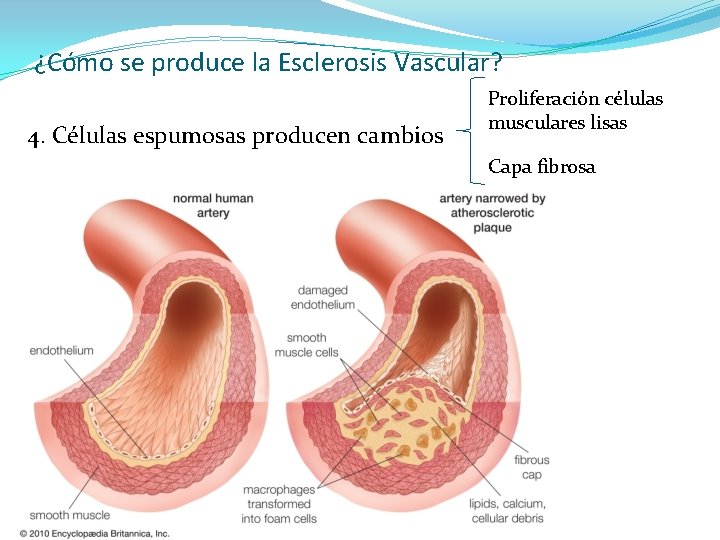 ¿Cómo se produce la Esclerosis Vascular? 4. Células espumosas producen cambios Proliferación células musculares