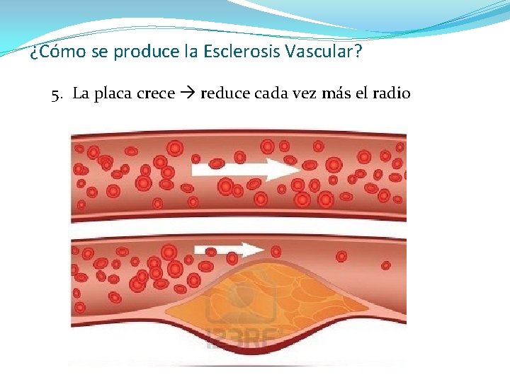 ¿Cómo se produce la Esclerosis Vascular? 5. La placa crece reduce cada vez más