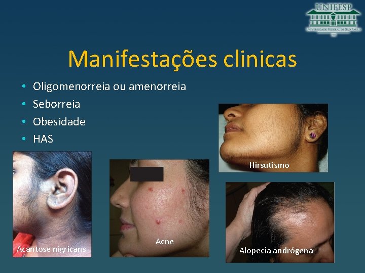 Manifestações clinicas • • Oligomenorreia ou amenorreia Seborreia Obesidade HAS Hirsutismo Acantose nigricans Acne