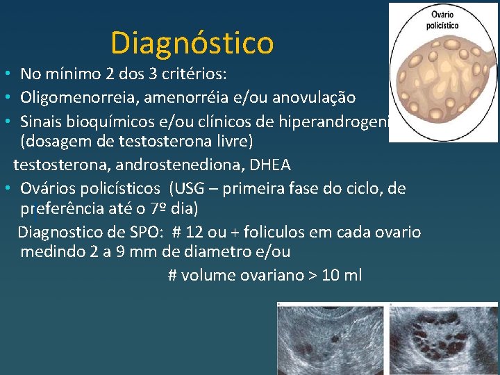 Diagnóstico • No mínimo 2 dos 3 critérios: • Oligomenorreia, amenorréia e/ou anovulação •