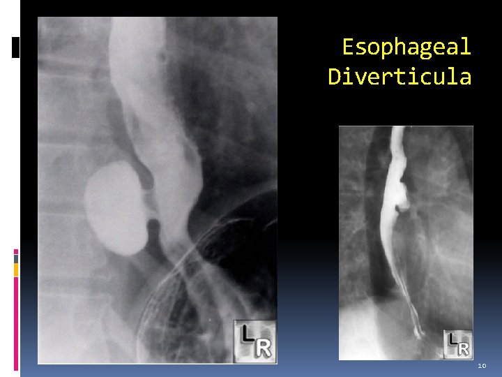 Esophageal Diverticula 10 