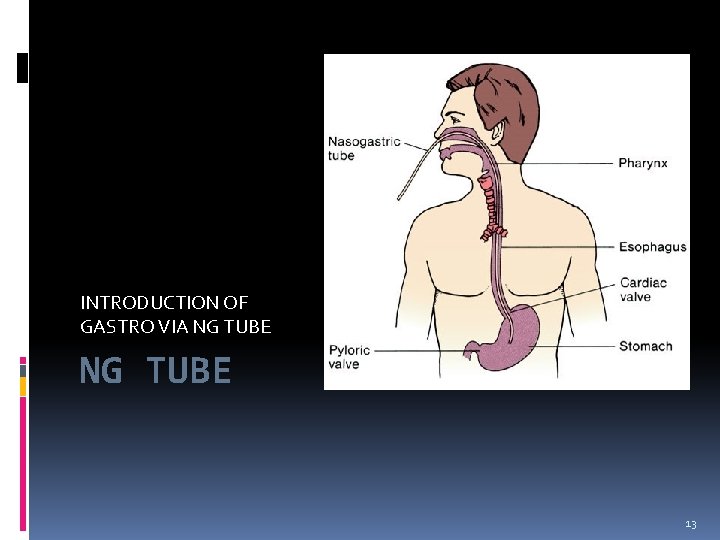 INTRODUCTION OF GASTRO VIA NG TUBE 13 