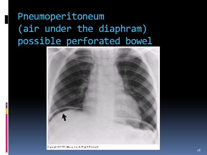 Pneumoperitoneum (air under the diaphram) possible perforated bowel 16 