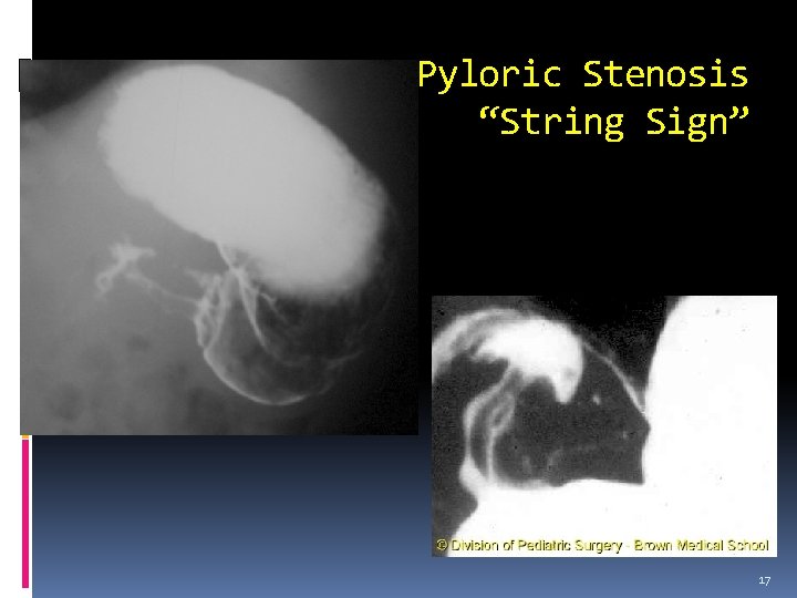 Pyloric Stenosis “String Sign” 17 