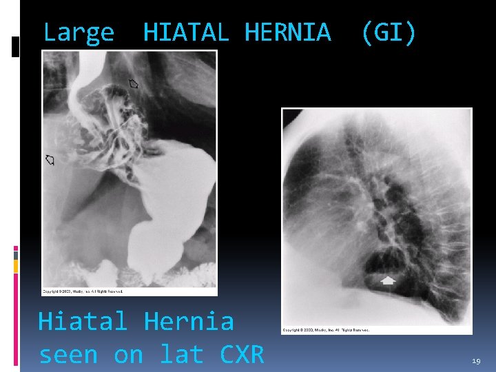Large HIATAL HERNIA Hiatal Hernia seen on lat CXR (GI) 19 