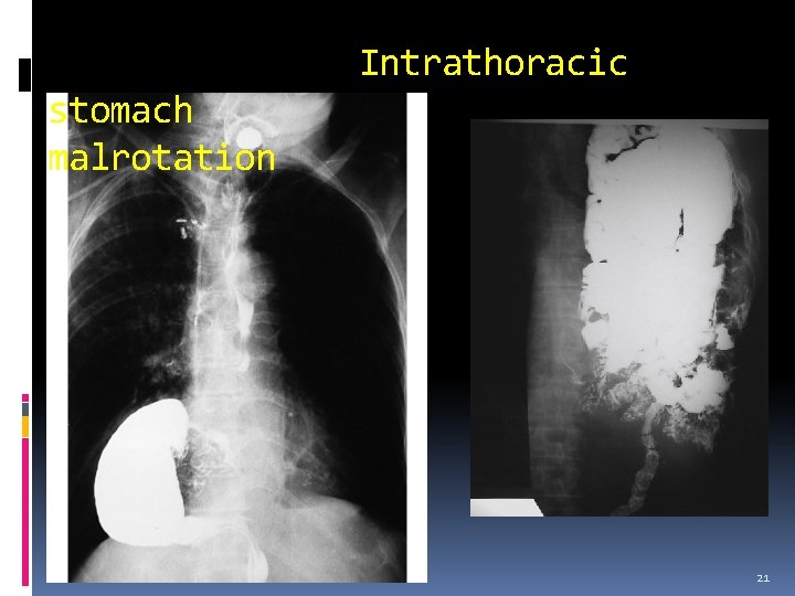 Intrathoracic stomach malrotation 21 