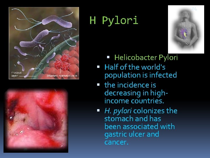 24 H Pylori Helicobacter Pylori Half of the world's population is infected the incidence