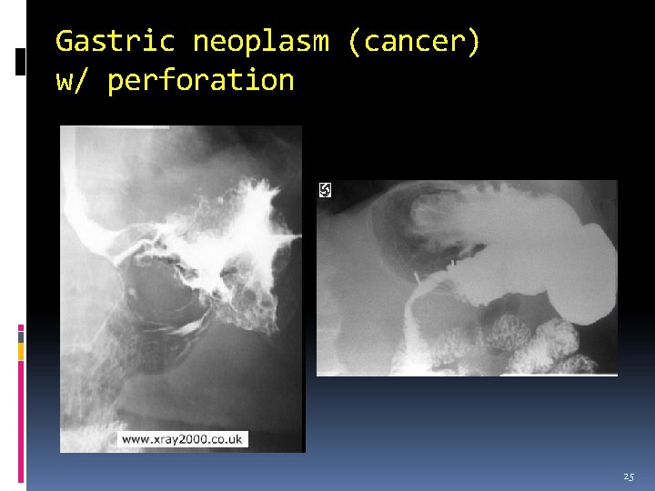 Gastric neoplasm (cancer) w/ perforation 25 
