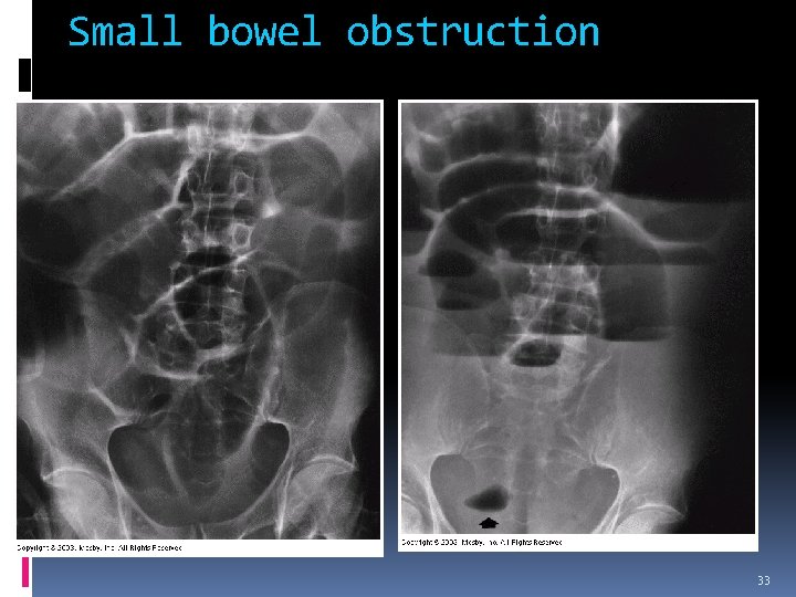 Small bowel obstruction 33 
