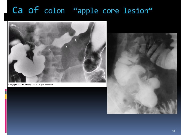 Ca of colon “apple core lesion” 36 