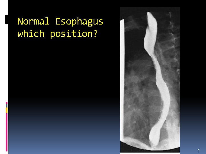 Normal Esophagus which position? 4 