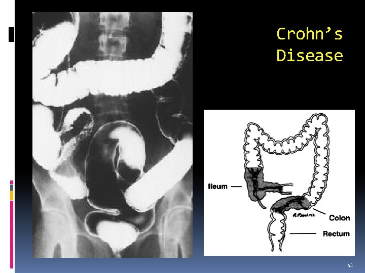 Crohn’s Disease 41 
