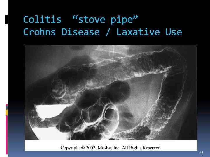 Colitis “stove pipe” Crohns Disease / Laxative Use 43 