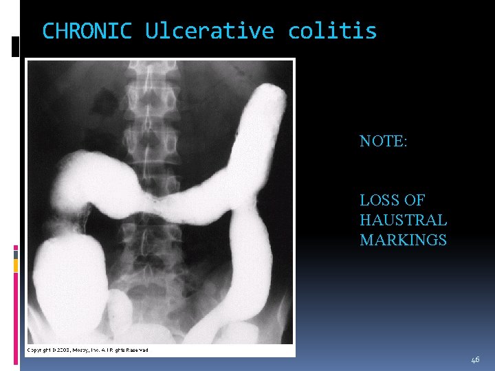 CHRONIC Ulcerative colitis NOTE: LOSS OF HAUSTRAL MARKINGS 46 