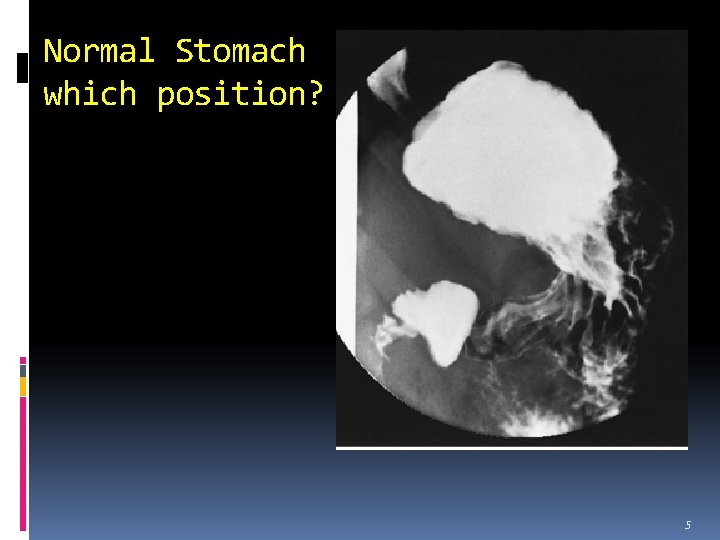 Normal Stomach which position? 5 