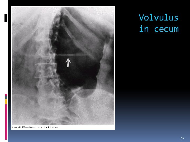 Volvulus in cecum 51 