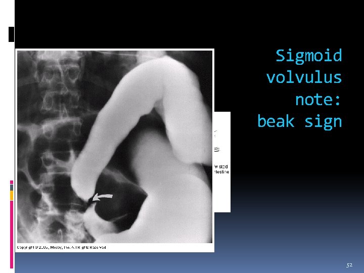 Sigmoid volvulus note: beak sign 52 