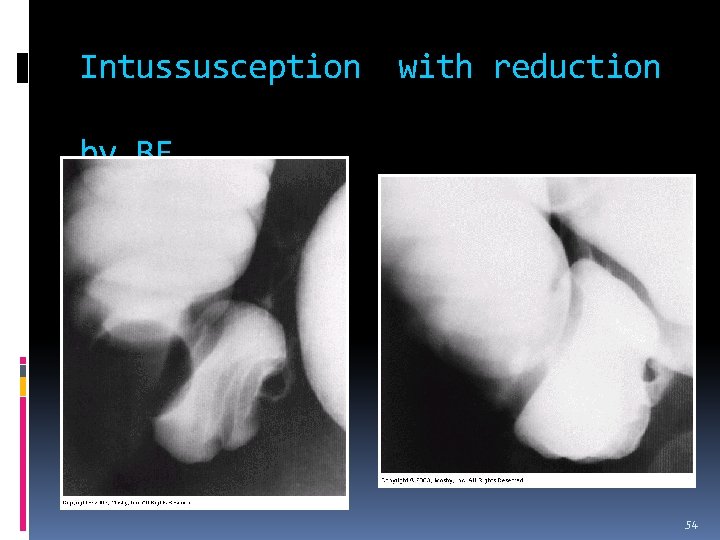 Intussusception with reduction by BE 54 