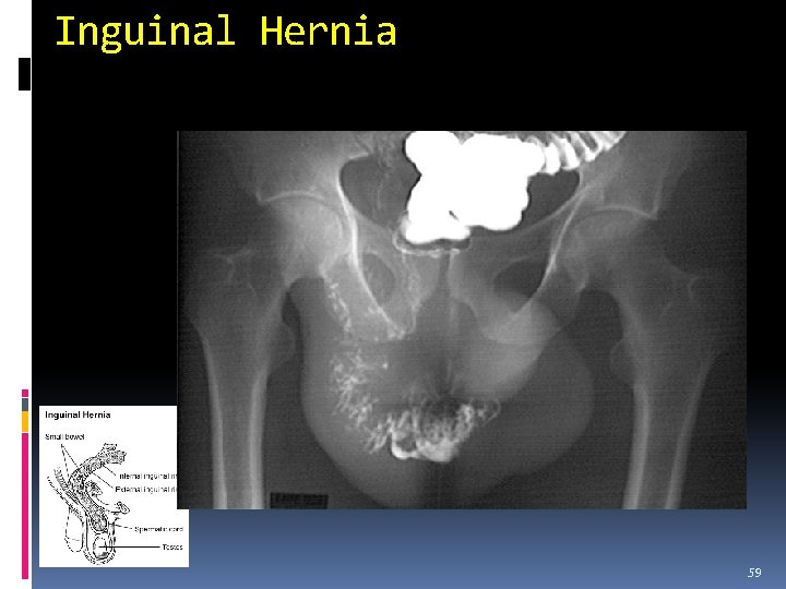 Inguinal Hernia 59 