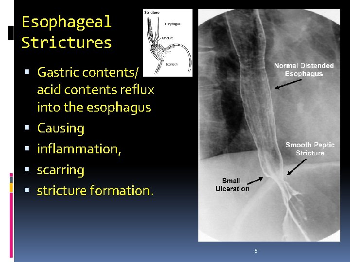 Esophageal Strictures Gastric contents/ acid contents reflux into the esophagus Causing inflammation, scarring stricture