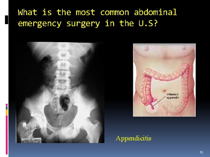 What is the most common abdominal emergency surgery in the U. S? Appendicitis 63