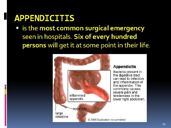 APPENDICITIS is the most common surgical emergency seen in hospitals. Six of every hundred